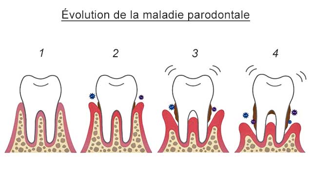 Parodontite : Symptômes, causes et traitements