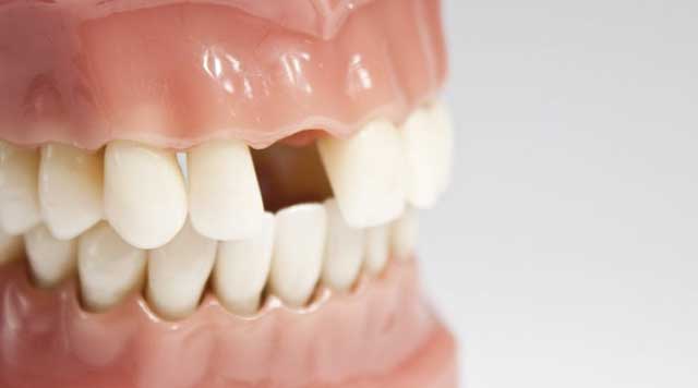 Perte des dents permanentes : causes et solutions