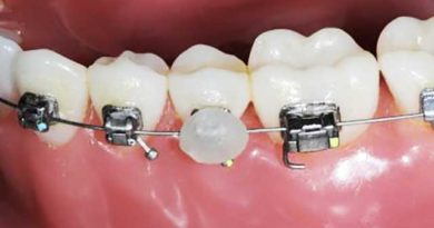 Qu'est-ce que la cire orthodontique et comment l’utiliser ?