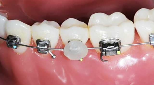 Qu'est-ce que la cire orthodontique et comment l’utiliser ?