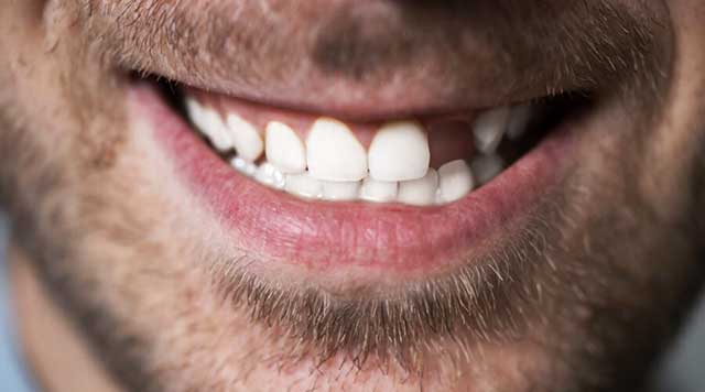 Les conséquences du non-remplacement des dents extraites ou absentes –  L'Information Dentaire