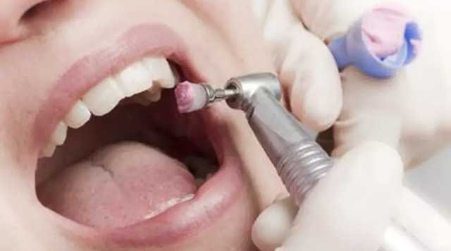 Détartrage et polissage des dents