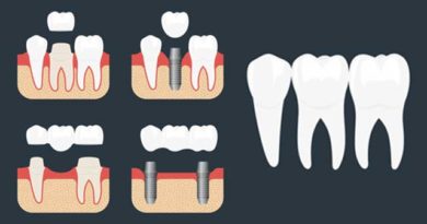 Options de traitement pour des dents manquantes