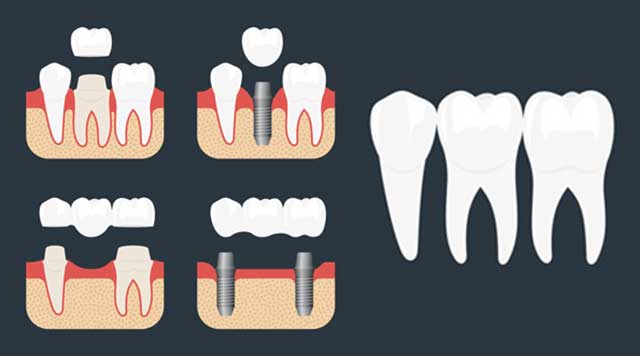 Options de traitement pour des dents manquantes