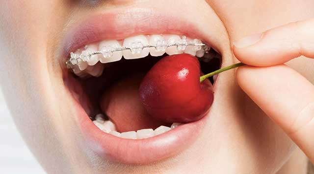 Bagues dentaires : Que manger avec et comment ?