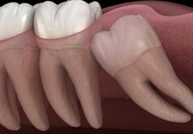 Les dents de sagesse arrivent : signes et symptômes