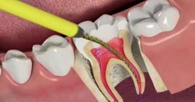 Dévitalisation dentaire : ce que cela signifie