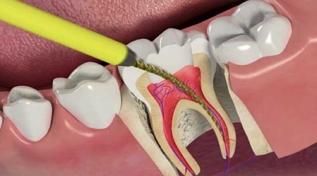 Dévitalisation dentaire : ce que cela signifie