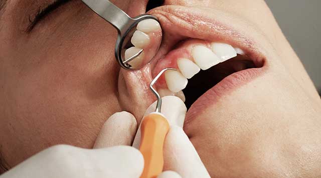 9 choses à savoir sur le traitement et la guérison de la parodontite