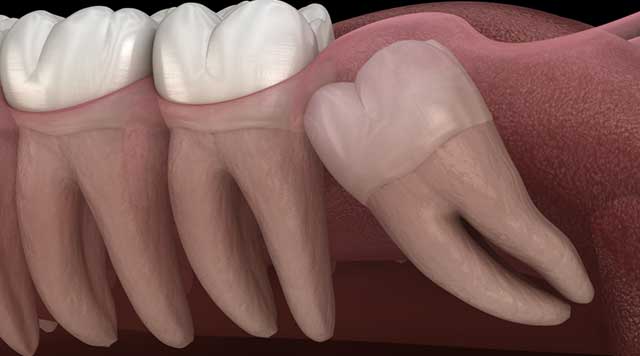 Les dents de sagesse arrivent : signes et symptômes