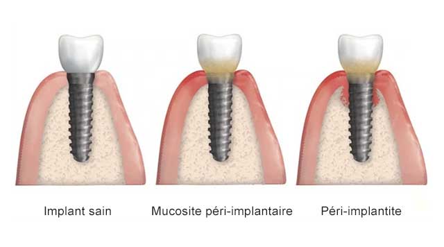 Qu’est-ce que la péri-implantite ?