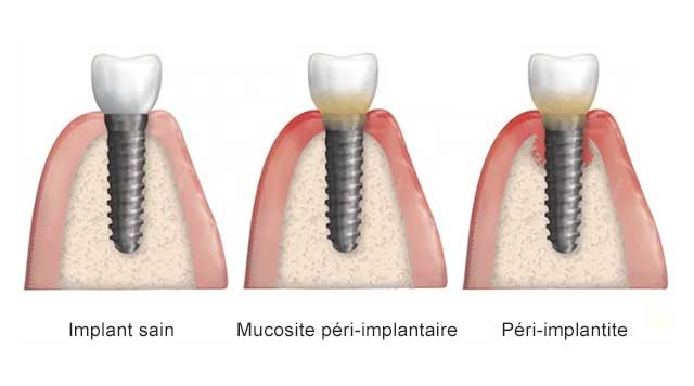 Qu est ce Qu une P ri implantite Ma Sant Bucco dentaire