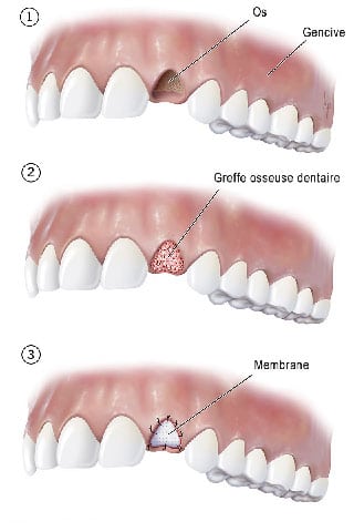 La greffe osseuse dentaire