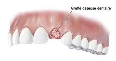 La greffe osseuse dentaire