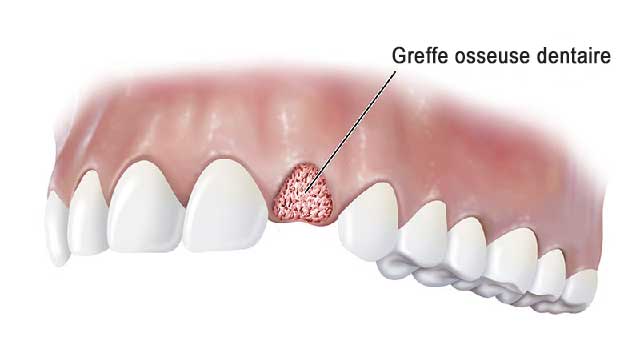 La greffe osseuse dentaire