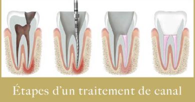 Traitement de canal dentaire de A à Z