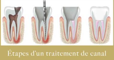 Traitement de canal dentaire de A à Z
