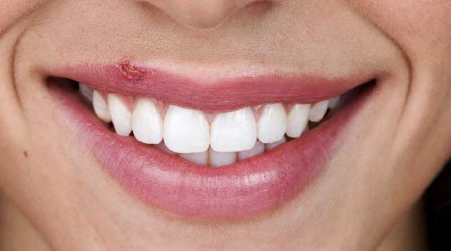 Boutons de fièvre : symptômes, causes et traitements