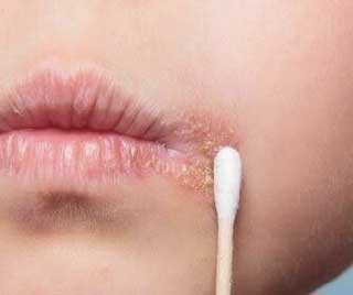 Boutons de fièvre : symptômes, causes et traitements