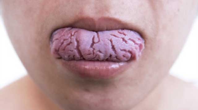 Qu'est-ce qui cause la langue fissurée ? -