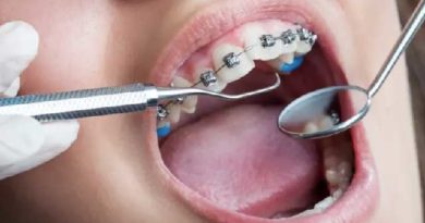 Soins orthodontiques : Quand et comment ?