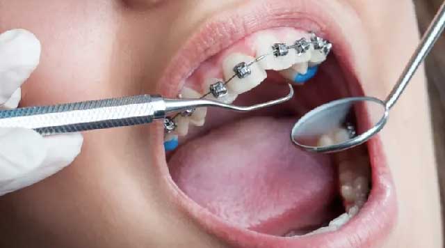 Soins orthodontiques : Quand et comment ?