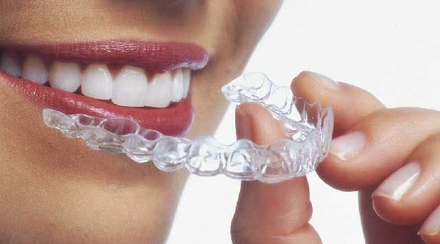 Aligneurs invisibles pour les dents