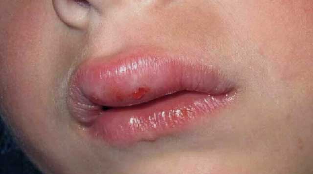 Lèvres enflées : causes et traitements -