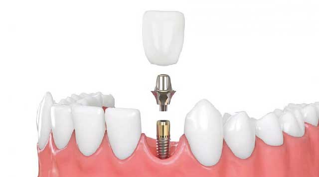 La pose des implants dentaires
