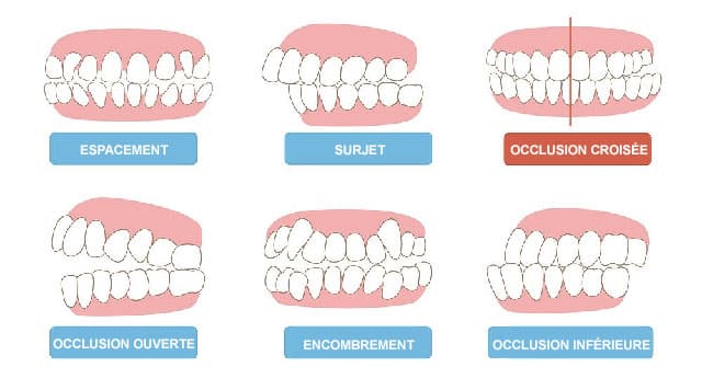 Qu'est-ce que la malocclusion dentaire et comment la traiter ?