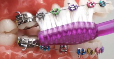 6 types d' urgences orthodontiques