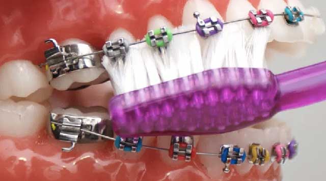 6 types d' urgences orthodontiques