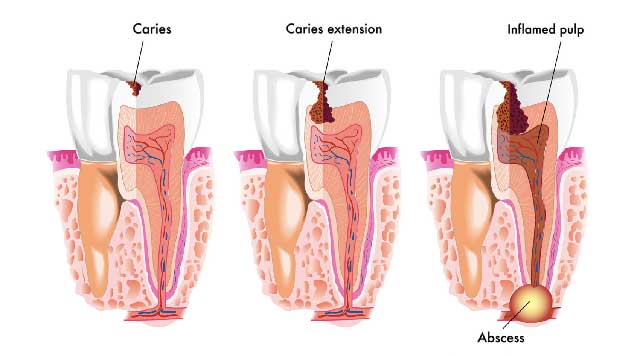 Dental caries : causes and treatments