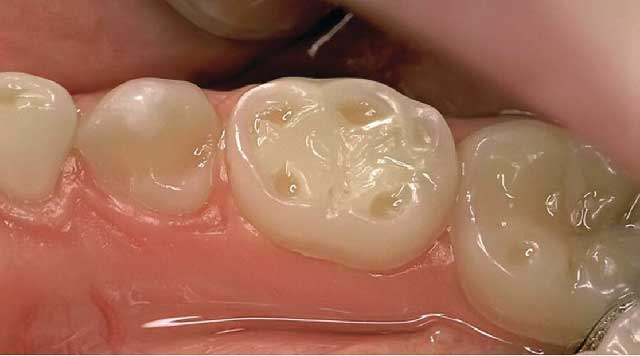 Érosion dentaire