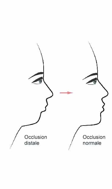 Occlusion distale