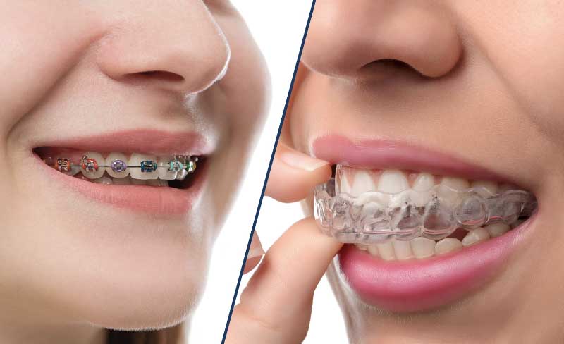 Traitements de malocclusion