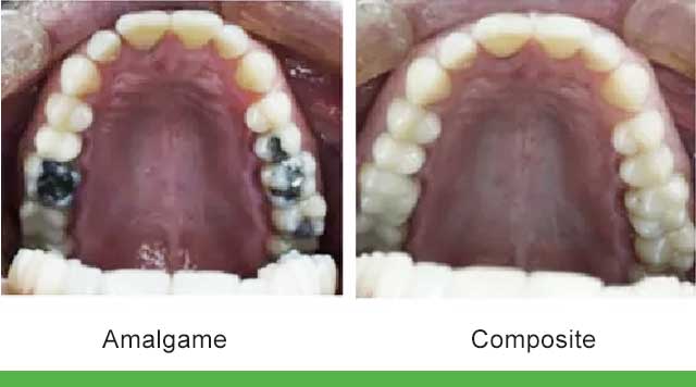 Composite ou amalgame : Que choisir ?