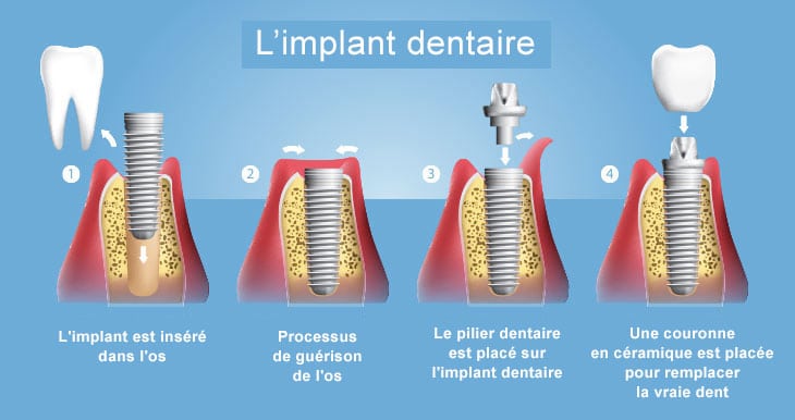 Étapes de pose d'implant denraire