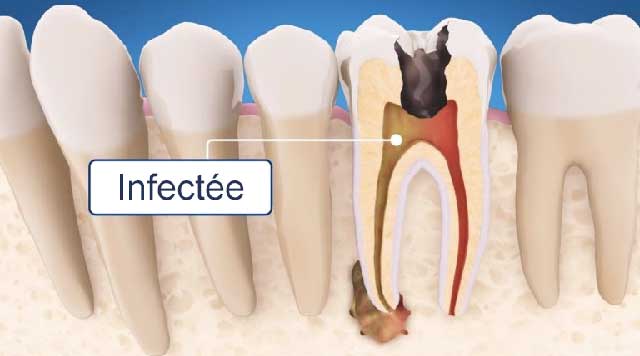 Que se passe-t-il si l'infection de la racine de la dent n'est pas traitée ?