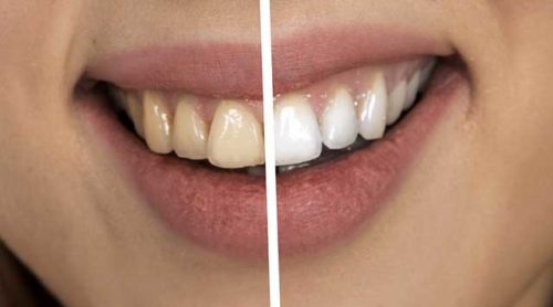 Comment éliminer le tartre des dents ? - Ma santé bucco-dentaire