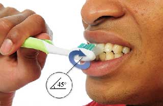 Comment prévenir la plaque dentaire