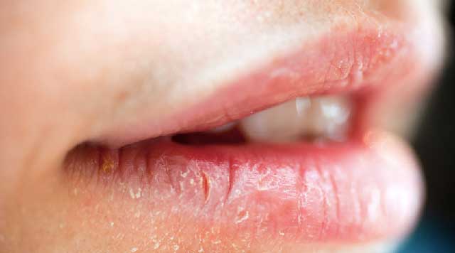 Lèvres gercées : Symptômes, causes, diagnostic, traitement et prévention