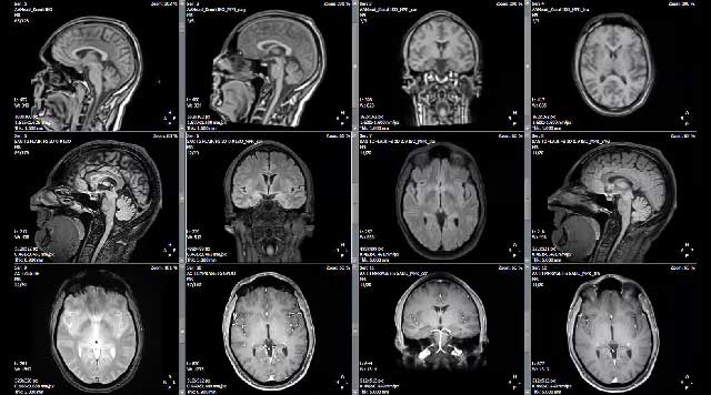 La mauvaise santé bucco-dentaire est liée au déclin de la santé cérébrale