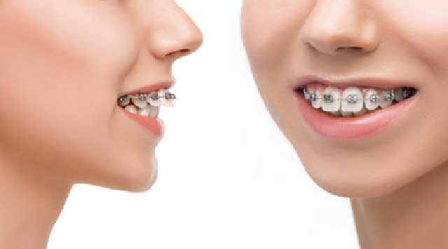 Protrusion dentaire : causes et traitements