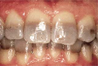 dents grises à cause d'un traitement à la tetracycline.