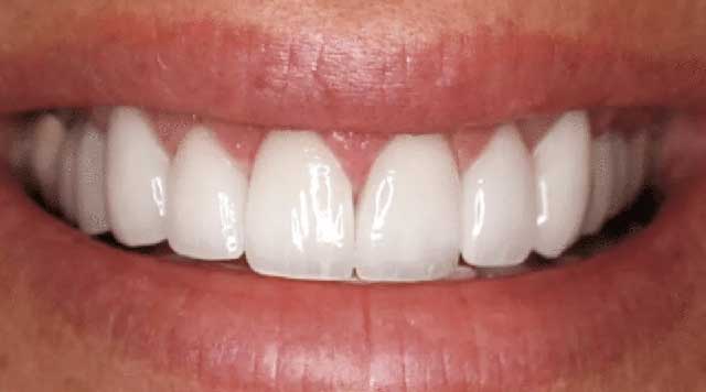 D'où viennent les dents transparentes ? Causes et traitements ?