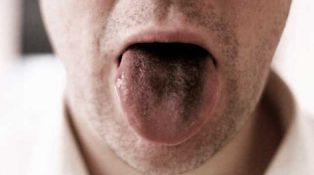 Qu'est-ce que la langue noire poilue ?