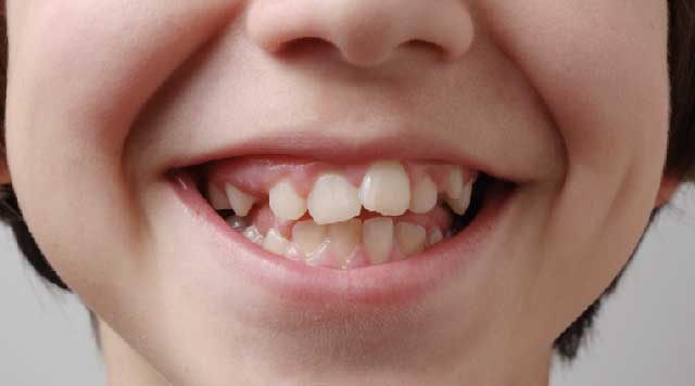 L'orthodontie interceptive en dentisterie pédiatrique