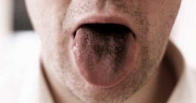 Qu'est-ce que la langue noire poilue ?