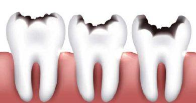 Comment prévenir la carie dentaire ?